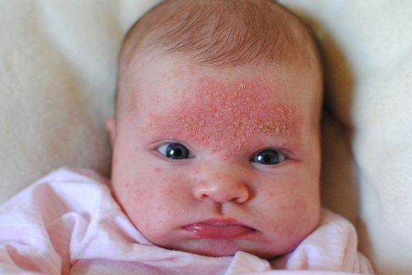 Bệnh viêm da tiết bã ở trẻ sơ sinh - Triệu chứng, nguyên nhân và cách điều trị