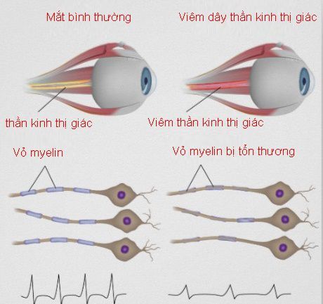 Bệnh viêm dây thần kinh thị giác - Triệu chứng, nguyên nhân và cách điều trị