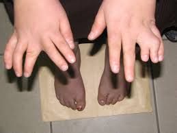 Hội chứng Bardet-Biedl - Bệnh dị tật các ngón tay chân