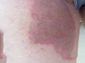 Bệnh nấm bẹn - Triệu chứng, nguyên nhân và cách điều trị