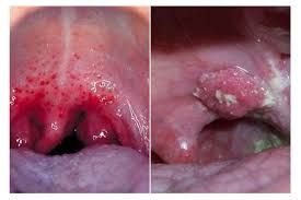 Bệnh nấm họng - Triệu chứng, nguyên nhân và cách điều trị