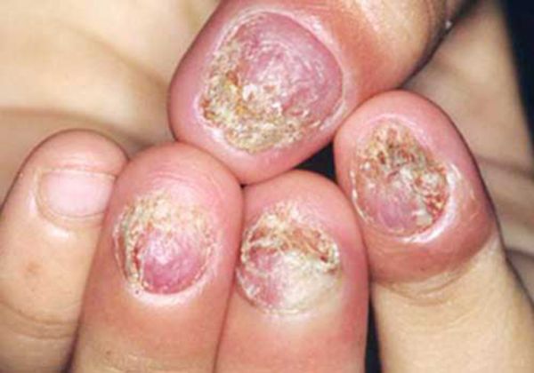 Bệnh nấm móng chân - Triệu chứng, nguyên nhân và cách điều trị