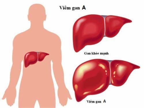 Bệnh viêm gan A - Triệu chứng, nguyên nhân và cách điều trị