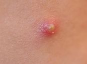 Mủ - Triệu chứng, nguyên nhân và cách điều trị