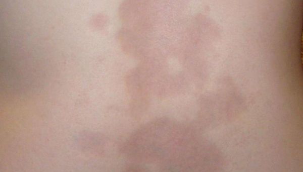 Bệnh morphea - Triệu chứng, nguyên nhân và cách điều trị