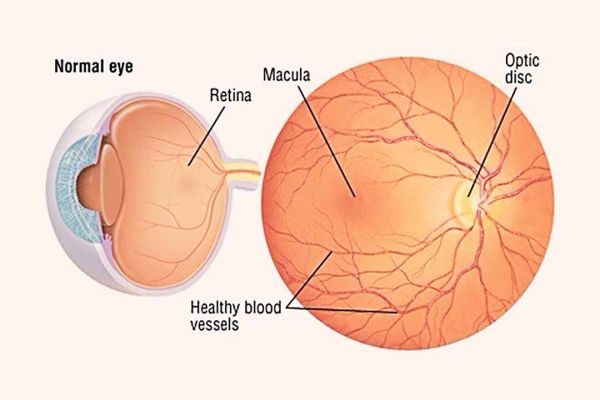 Phân tích nguy cơ thoái hóa điểm vàng liên quan đến tuổi - Những lưu ý cần biết