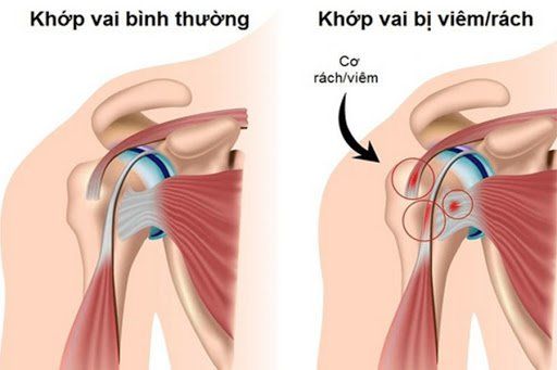 Bệnh viêm gân cơ quay khớp vai - Triệu chứng, nguyên nhân và cách điều trị