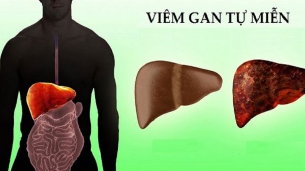 Bệnh viêm gan tự miễn - Triệu chứng, nguyên nhân và cách điều trị