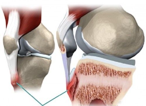 Bệnh viêm gân xương bánh chè - Triệu chứng, nguyên nhân và cách điều trị