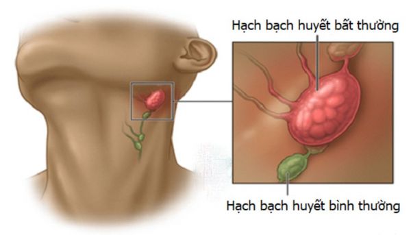 Bệnh viêm hạch bạch huyết - Triệu chứng, nguyên nhân và cách điều trị