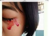 Bệnh mồ hôi máu - Triệu chứng, nguyên nhân và cách điều trị