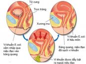 Nhiễm trùng đường tiết niệu - Triệu chứng, nguyên nhân và cách điều trị