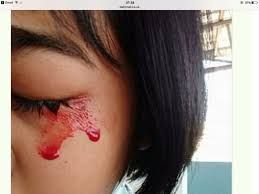 Bệnh mồ hôi máu - Triệu chứng, nguyên nhân và cách điều trị