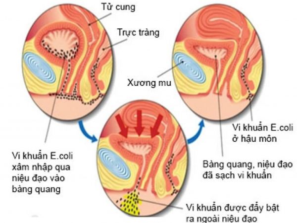 Nhiễm trùng đường tiết niệu - Triệu chứng, nguyên nhân và cách điều trị