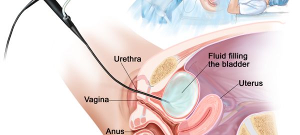 Thủ thuật nội soi bàng quang - Quy trình thực hiện và những lưu ý cần biết