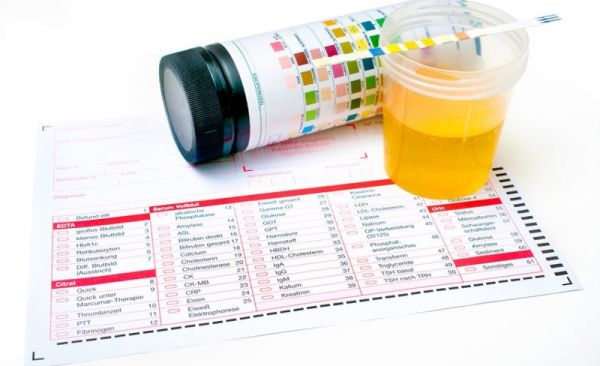 Xét nghiệm nồng độ glucose niệu - Quy trình thực hiện và những lưu ý cần biết