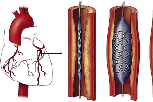 Thủ thuật nong mạch vành - Quy trình thực hiện và những lưu ý cần biết