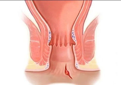 Hội chứng nứt hậu môn - Triệu chứng, nguyên nhân và cách điều trị