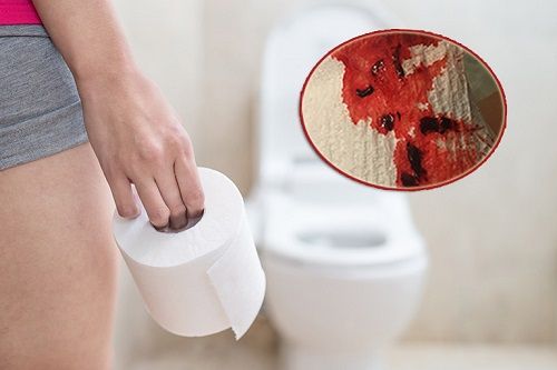 Phân có máu - Triệu chứng, nguyên nhân và cách điều trị