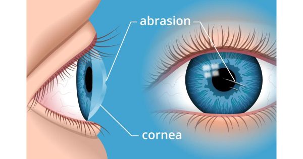 Hội chứng trợt giác mạc - Triệu chứng, nguyên nhân và cách điều trị