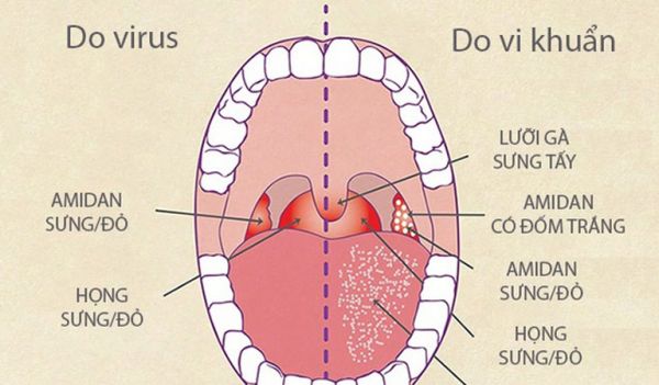 Bệnh viêm họng do virus - Triệu chứng, nguyên nhân và cách điều trị