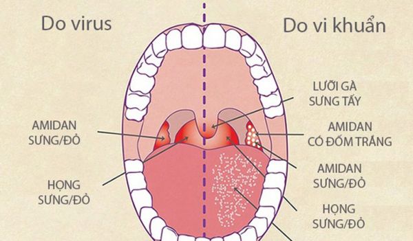 Bệnh viêm họng do virus - Triệu chứng, nguyên nhân và cách điều trị