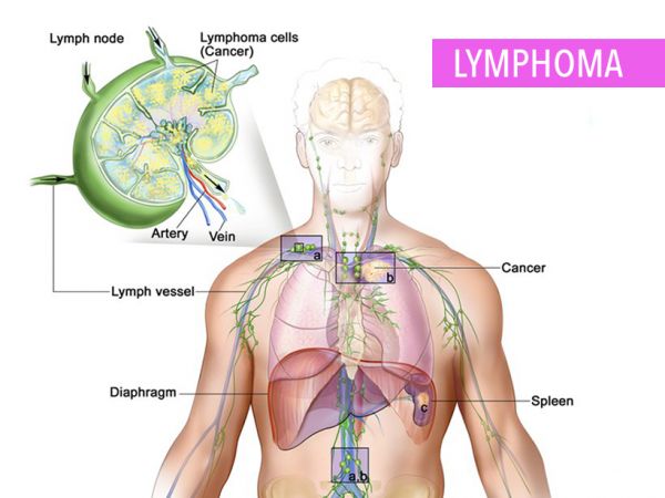 Bệnh Lymphoma - Triệu chứng, nguyên nhân và cách điều trị