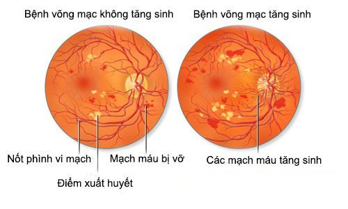 Bệnh màng tăng sinh trước võng mạc - Triệu chứng, nguyên nhân và cách điều trị