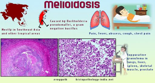 Bệnh melioidosis - Triệu chứng, nguyên nhân và cách điều trị
