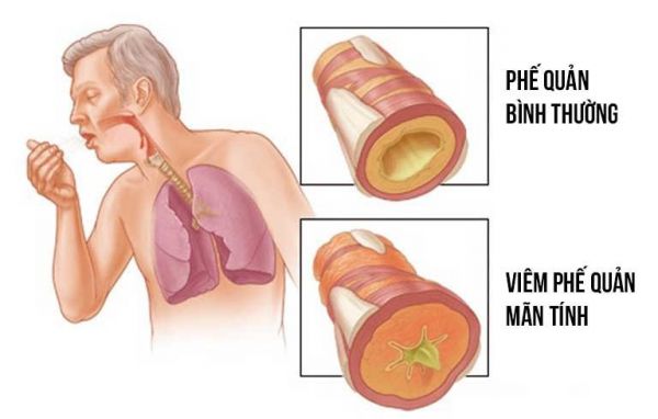 Bệnh viêm phế quản mạn tính - Triệu chứng, nguyên nhân và cách điều trị