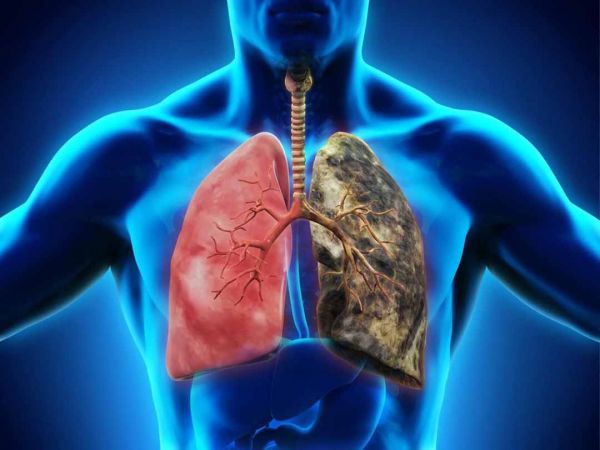Bệnh viêm phổi do hóa chất - Triệu chứng, nguyên nhân và cách điều trị