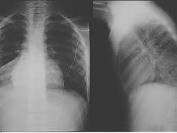 Bệnh viêm phổi do Mycoplasma - Triệu chứng, nguyên nhân và cách điều trị
