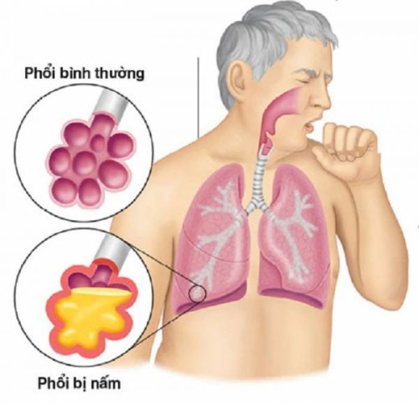 Bệnh viêm phổi do nấm - Triệu chứng, nguyên nhân và cách điều trị