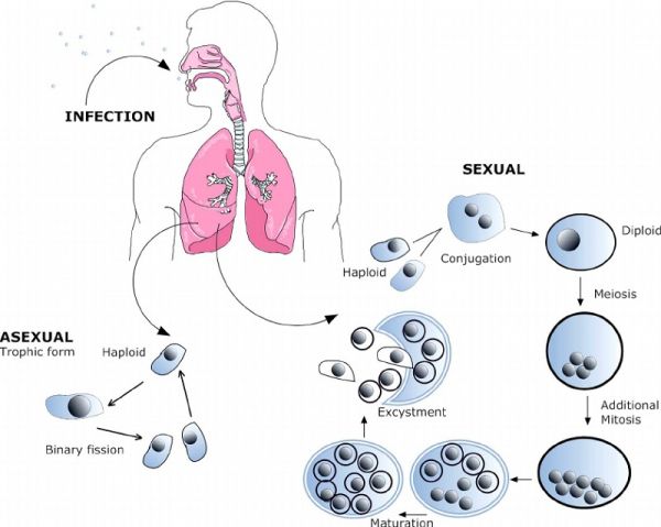 Bệnh viêm phổi do nhiễm trùng bào tử Pneumocystis - Triệu chứng, nguyên nhân và cách điều trị