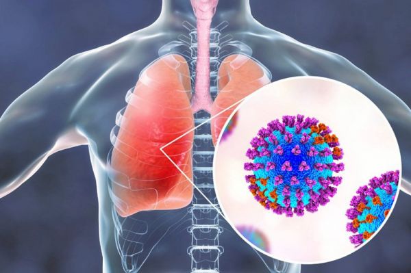 Bệnh viêm phổi do phế cầu - Triệu chứng, nguyên nhân và cách điều trị