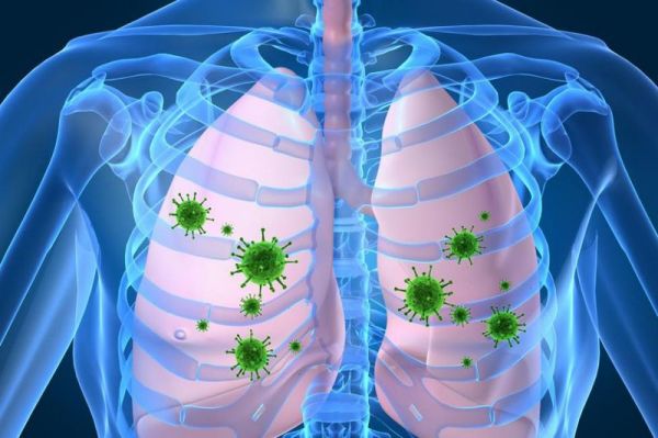 Bệnh viêm phổi do virus - Triệu chứng, nguyên nhân và cách điều trị