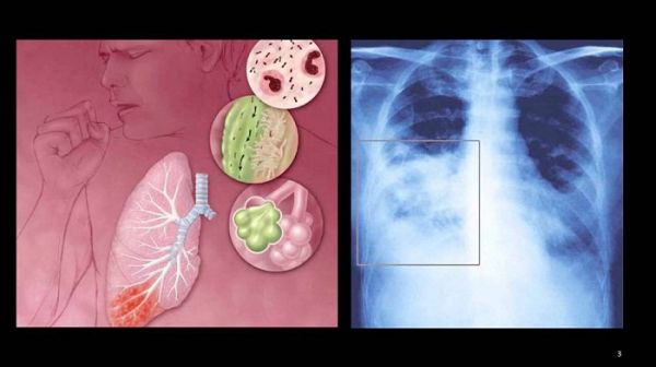 Bệnh viêm phổi không điển hình - Triệu chứng, nguyên nhân và cách điều trị