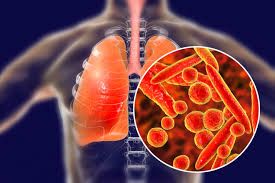 Bệnh viêm phổi vi khuẩn - Triệu chứng, nguyên nhân và cách điều trị