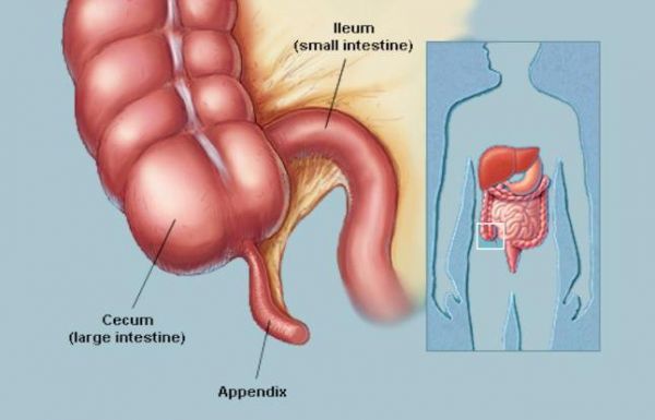 Bệnh viêm ruột thừa cấp - Triệu chứng, nguyên nhân và cách điều trị