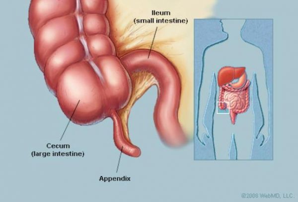 Bệnh viêm ruột - Triệu chứng, nguyên nhân và cách điều trị