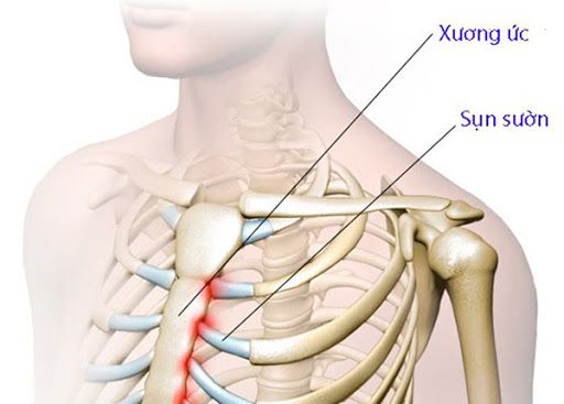 Bệnh viêm sụn sườn - Triệu chứng, nguyên nhân và cách điều trị