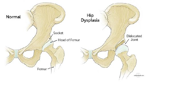 Bệnh loạn sản khớp háng - Triệu chứng, nguyên nhân và cách điều trị