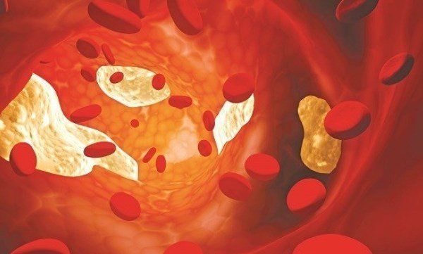 Nguyên tắc điều trị rối loạn lipoprotein máu