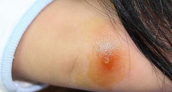 Bệnh nhiễm trùng - Triệu chứng, nguyên nhân và cách điều trị