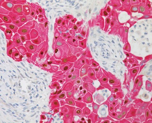 Bệnh ung thư biểu mô tế bào vảy - Triệu chứng, nguyên nhân và cách điều trị