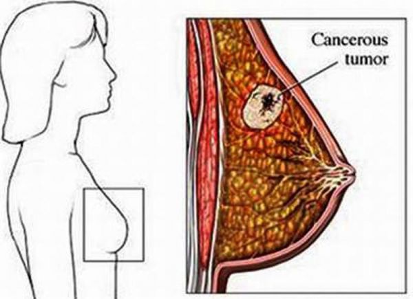 Bệnh ung thư biểu mô tiểu thùy tại chỗ - Triệu chứng, nguyên nhân và cách điều trị