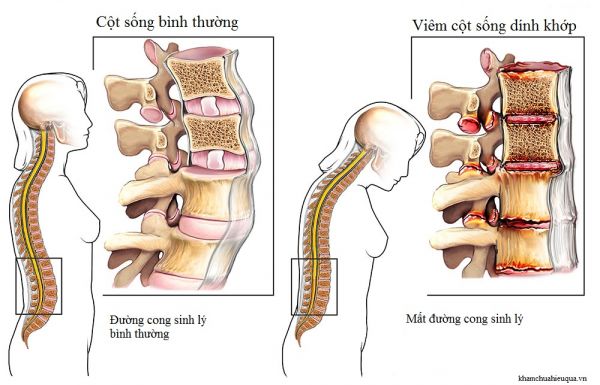 Bệnh viêm xương khớp cột sống - Triệu chứng, nguyên nhân và cách điều trị