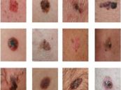 Bệnh ung thư da hắc sắc tố - Triệu chứng, nguyên nhân và cách điều trị