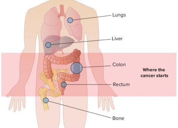 Hội chứng ung thư di căn - Triệu chứng, nguyên nhân và cách điều trị