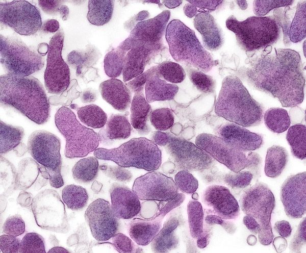 Bệnh nhiễm Mycoplasma Genitalium STD - Triệu chứng, nguyên nhân và cách điều trị